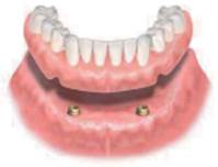 入れ歯が安定する固定式入れ歯インプラントオーバーデンチャーなら高松市の吉本歯科医院