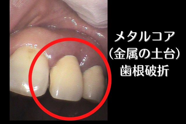 差し歯が折れ歯を抜かないといけないと言われた方｜高松市のインプラント治療の吉本歯科医院